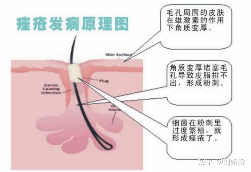 微粉刺怎么去怎么治疗才最有效