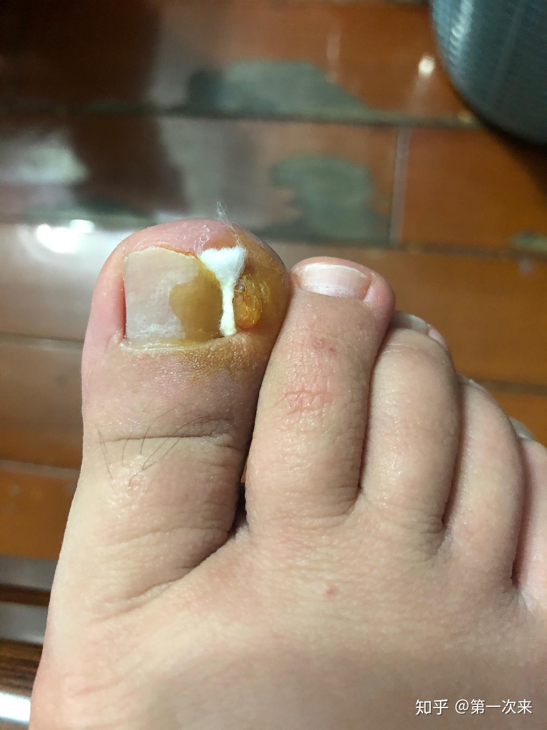 得了甲沟炎如何才能消除多余的肉芽