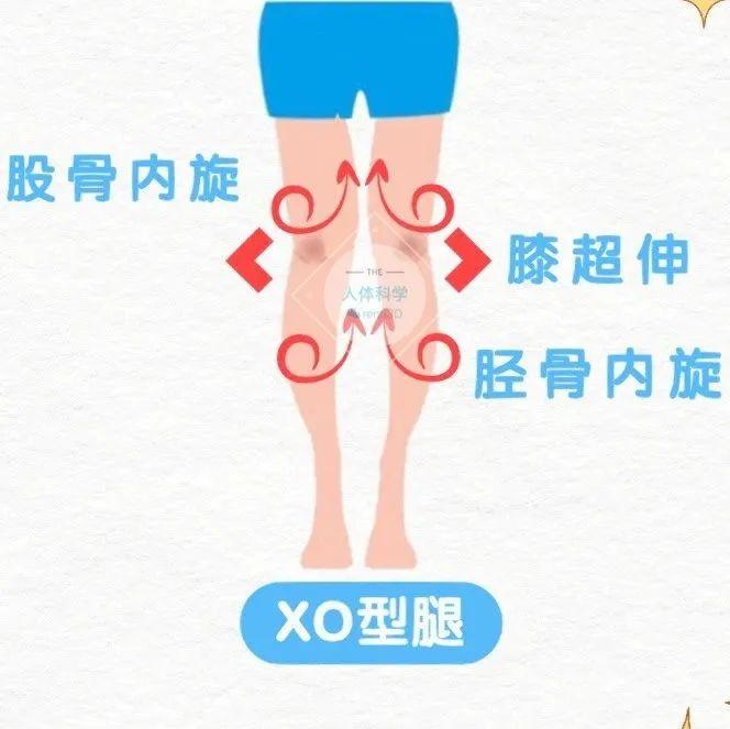 xo型腿矫正图解 最有效图片