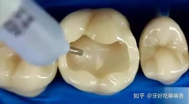 补牙需要注意什么? - 知乎
