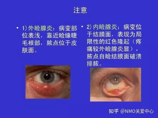 为什么眼睛总是爱长麦粒肿！！！？ - 知乎