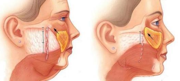 筋膜提升術有什麼風險面部筋膜提升術的危害太嚴重了害怕