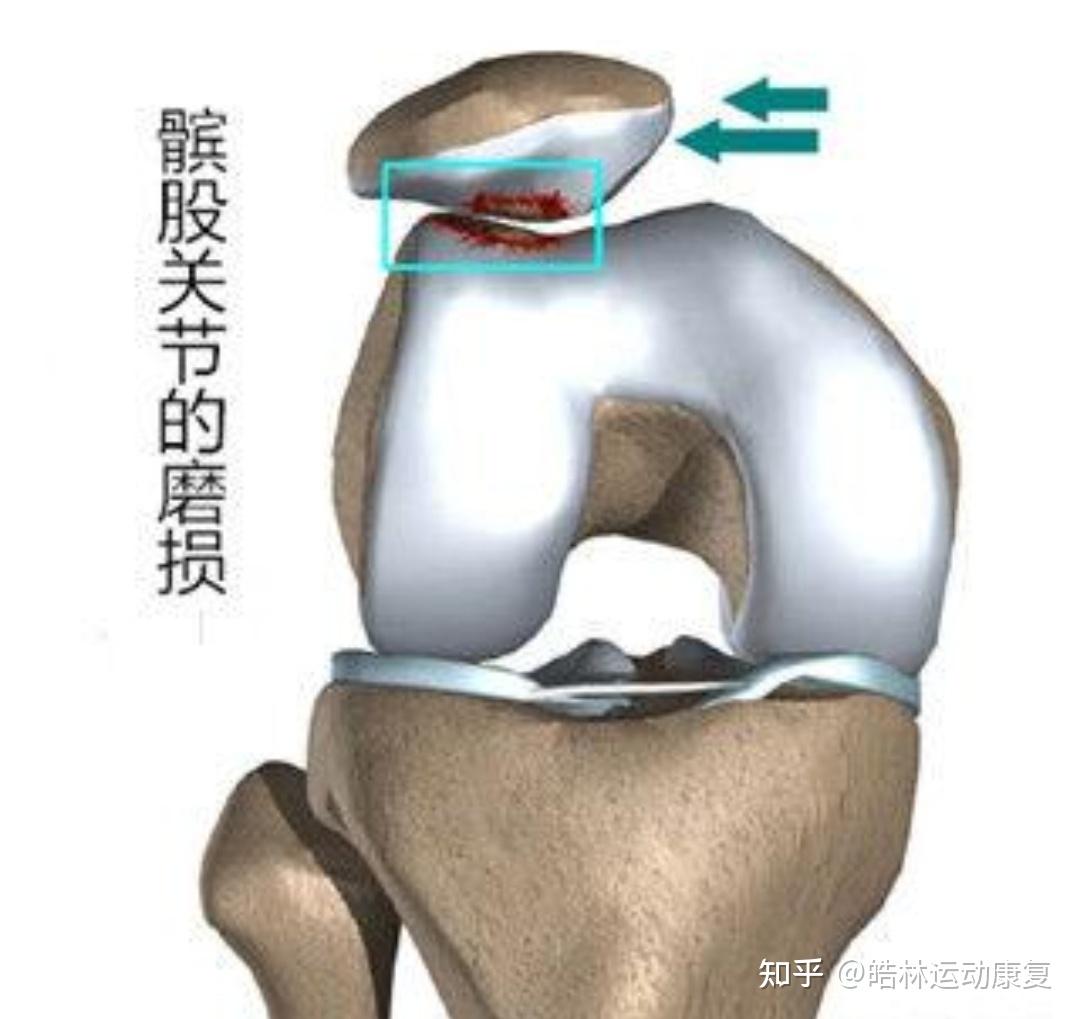 有一种膝关节疼，叫髌骨软化！到底什么叫髌骨软化？_凤凰网视频_凤凰网