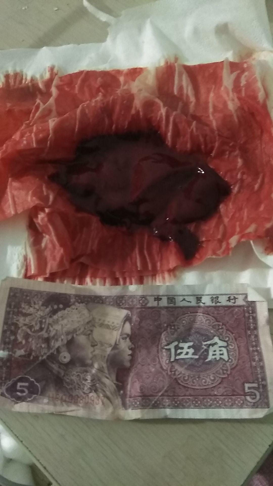 用梅花针拔气罐法从血液中出来的果冻状的东西是什么