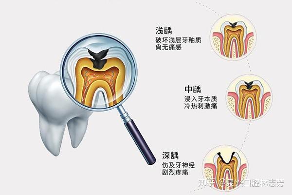 通過人造物質修補牙體缺損的方法,以恢復其外形和功能;一般對於因齲齒