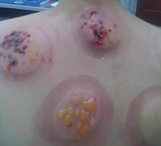 拔罐为啥 会舒服 v2-74b1104b947f680a997eeb98b9efb292_1440w.jpg?source=172ae18b