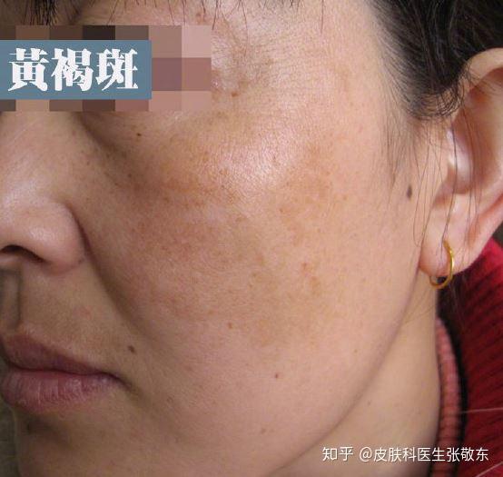 黄褐斑和褐青色痣都容易出现在颧骨周围该怎么区分
