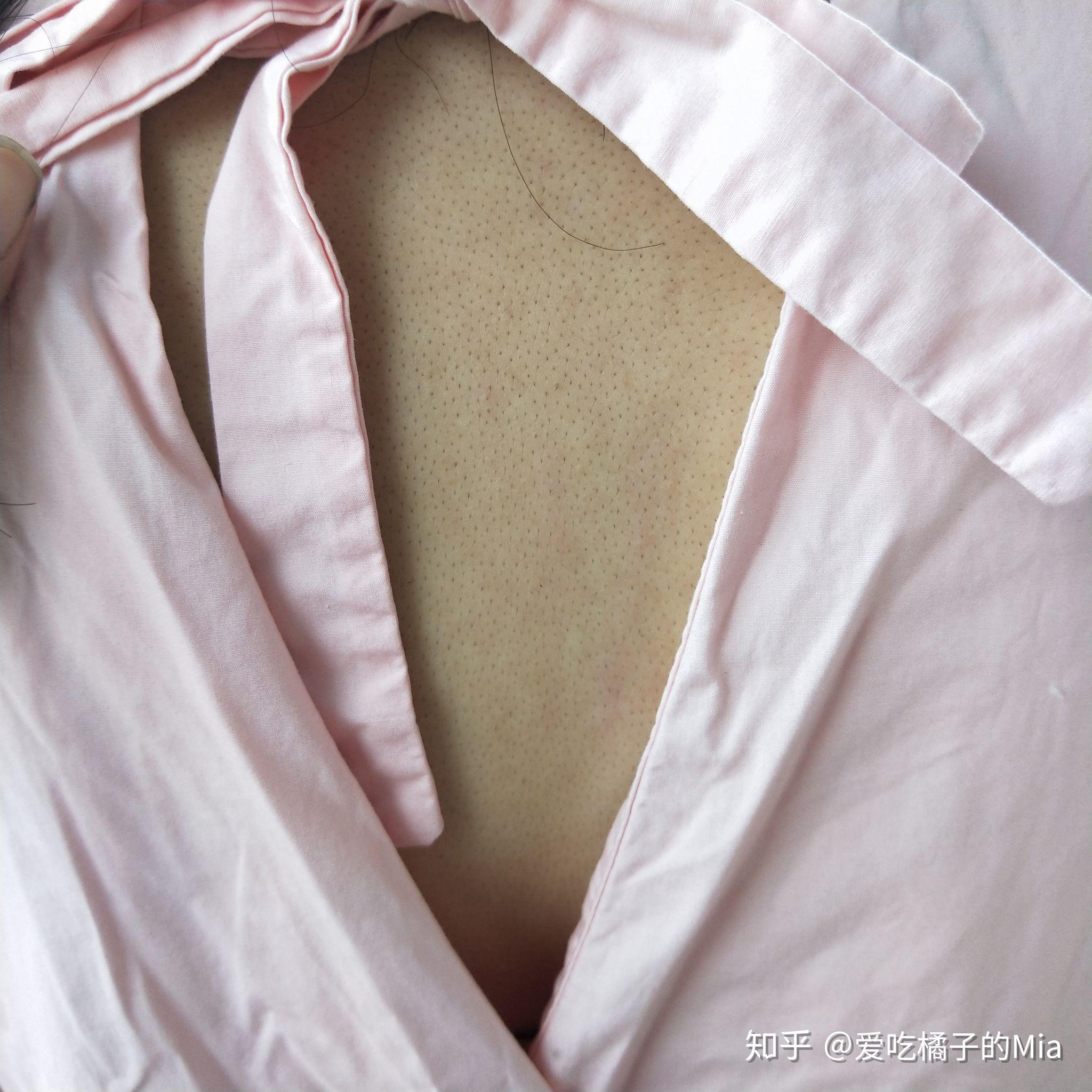 女生背上毛孔粗大怎么办