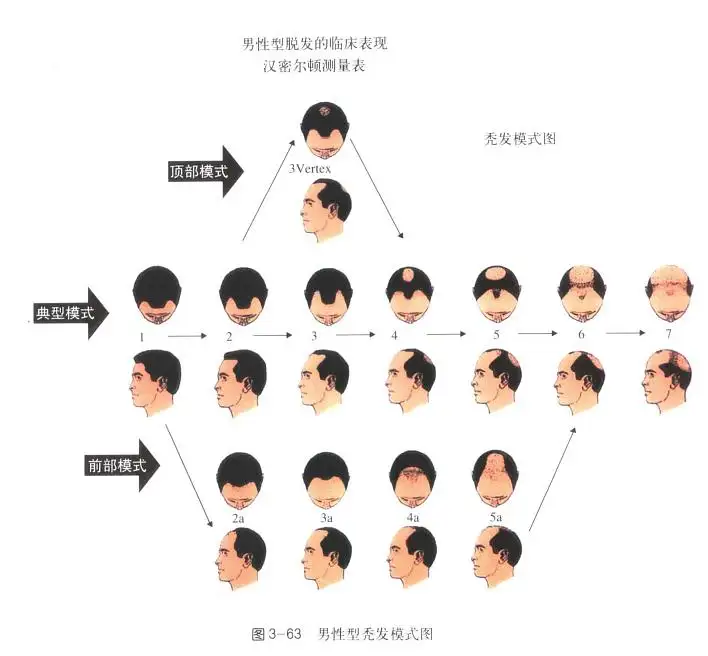 多年脱发治疗没效果,如今依靠这个方法长出头发 - 知乎