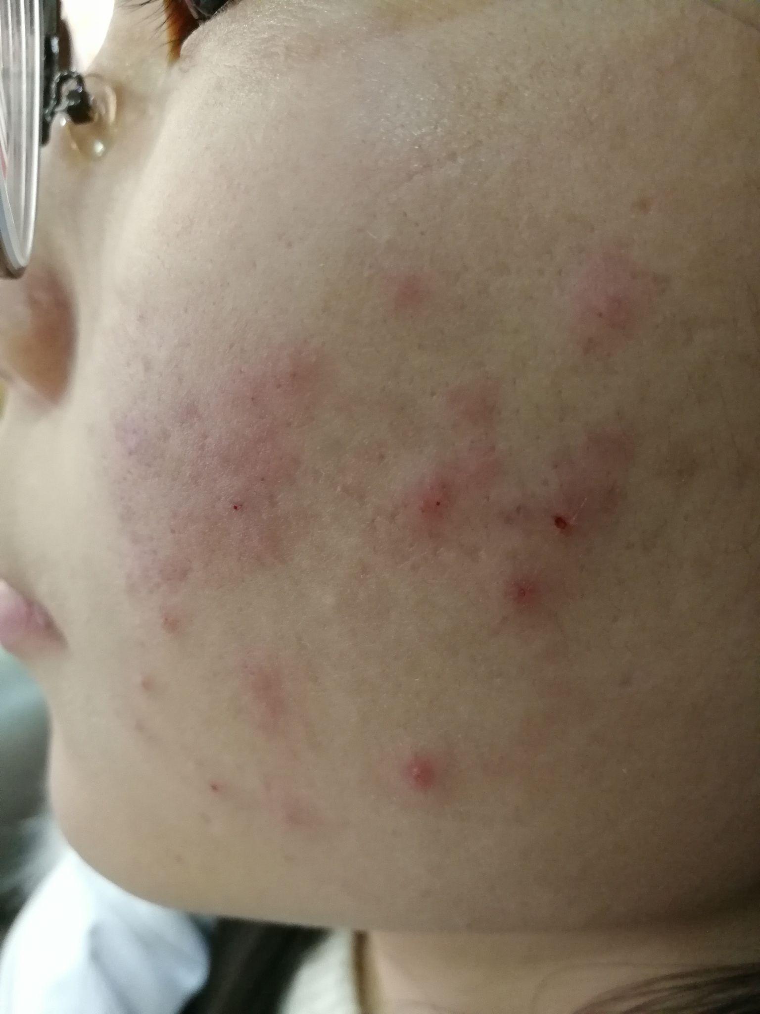 我脸上的红色痘印七八个月了，一直不下去，我该怎么办。？ - 知乎