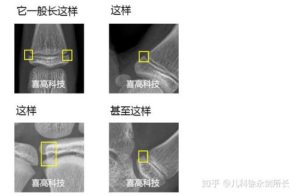 学习中华05标准骨龄鉴定的基础知识 - 知乎