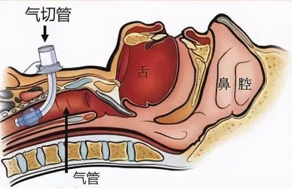 科普 | 气管插管和气管切开插管的区别 - 知乎