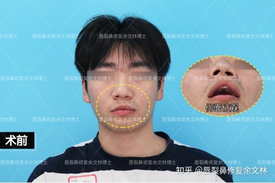 18岁成人礼:修复兔唇鼻畸形! - 知乎