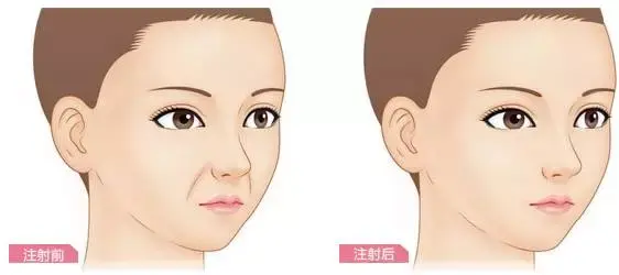 你之所以显老，大概就是鼻子旁的这条沟了~ - 知乎