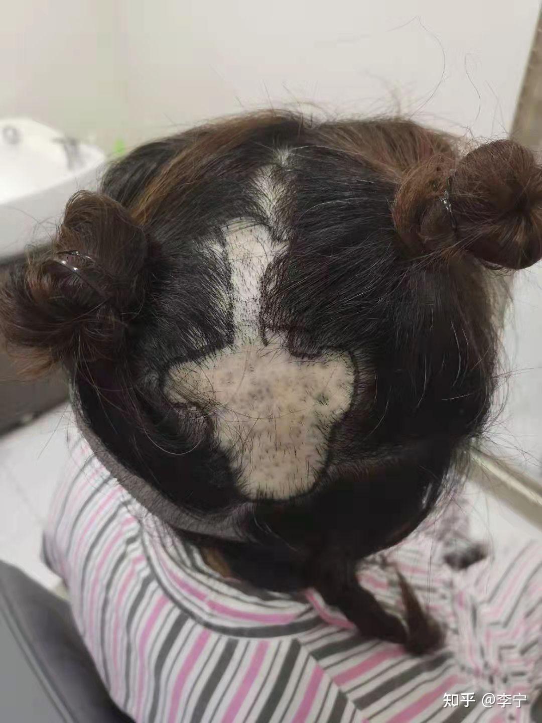 头皮疤痕性脱发该怎么办? - 知乎