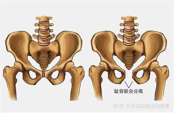 产后耻骨痛 你不知道耻骨分离到底有多可怕 深圳和佳运动康复 知乎