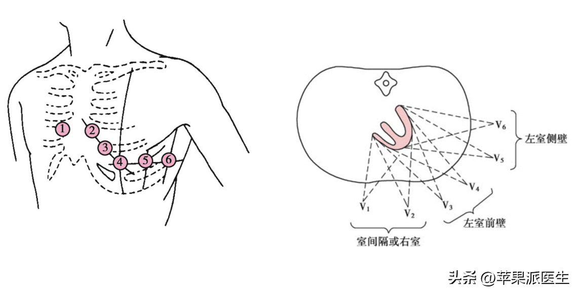 心电图判读(3):"典型的"急性心肌梗死