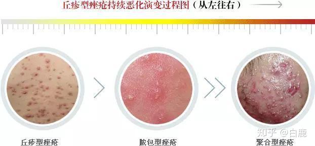 痘痘的分类(大全) - 知乎