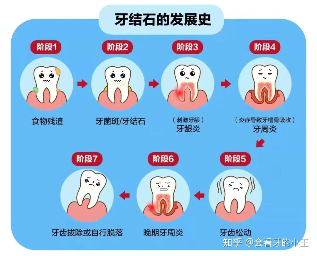 网上爆火的电动牙刷真的能刷掉牙结石吗2023年最新电动牙刷选购攻略