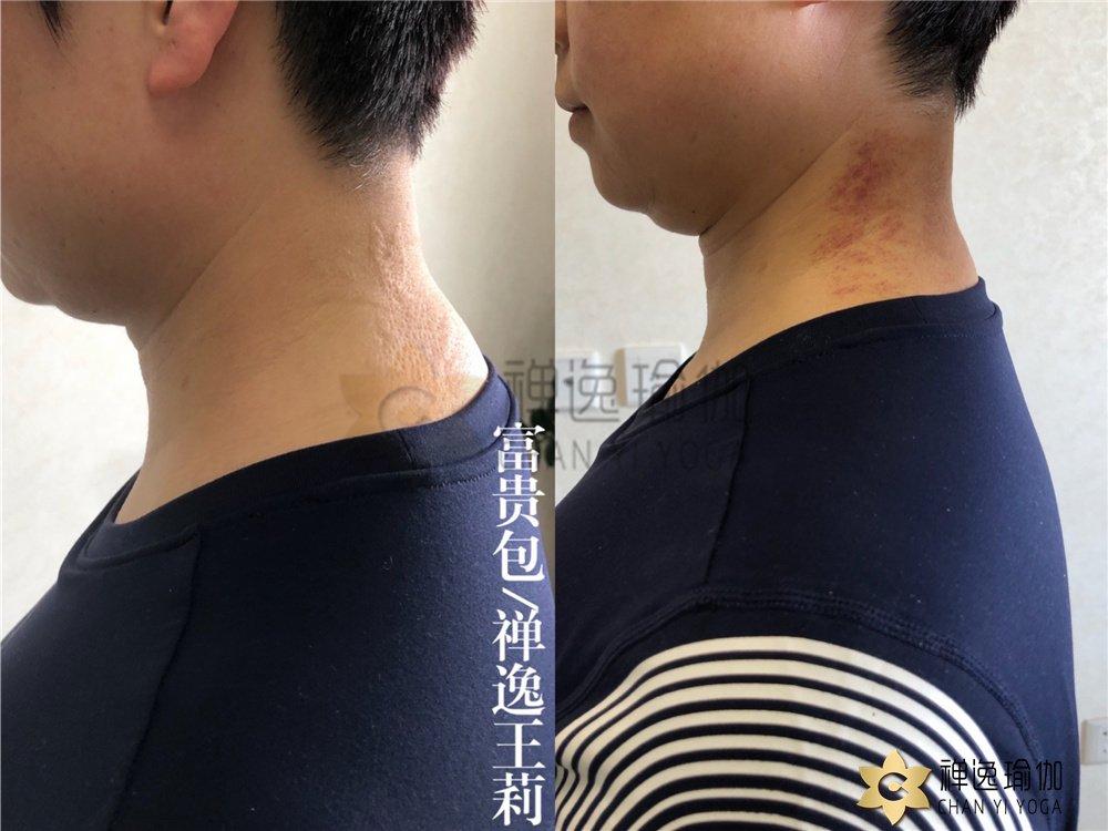 32岁怎么矫正驼背