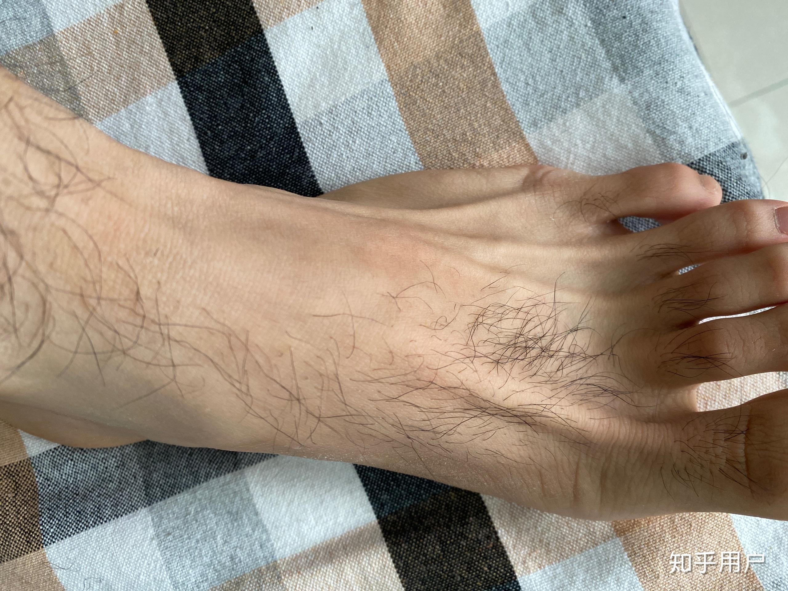 为什么脚大拇指的毛那么长