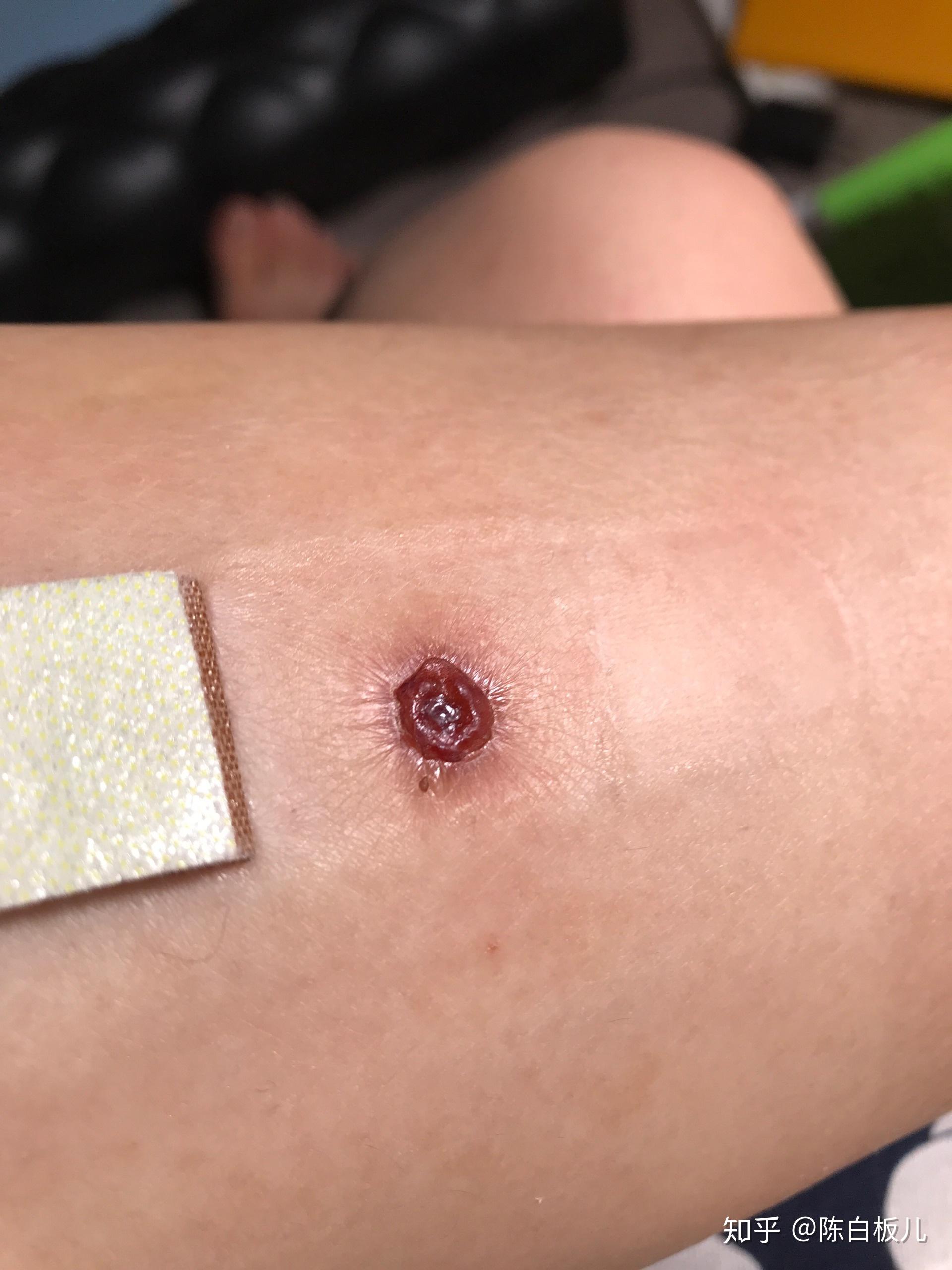 激光祛疣后如何避免留疤? - 知乎