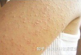 手臂和背上凸起的小颗粒是什么 知乎