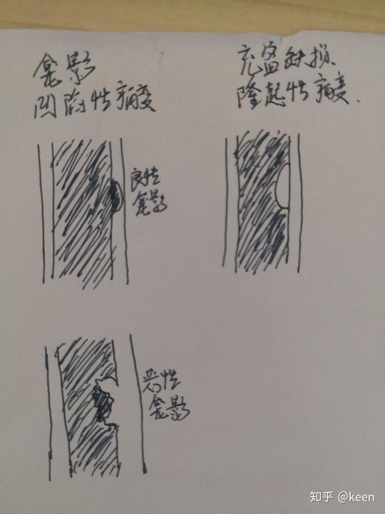 恶性龛影和充盈缺损都是向内凹陷的,那它们怎么区别呢?