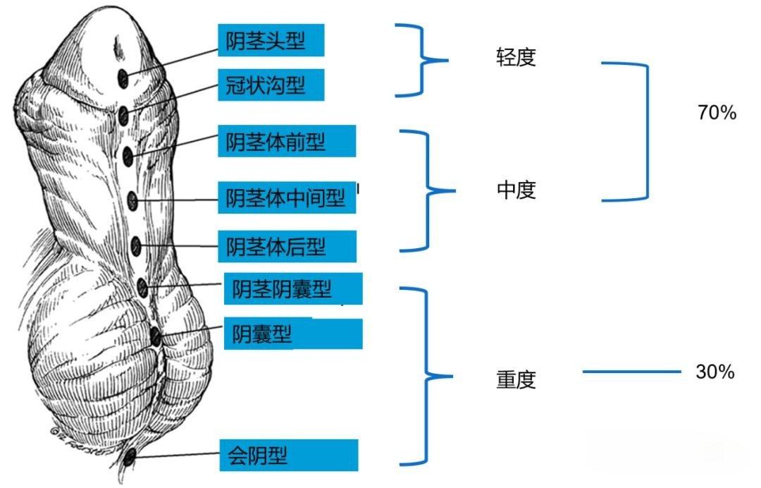 男宝宝必做的小JJ检查——300个中有一个有问题 - 知乎