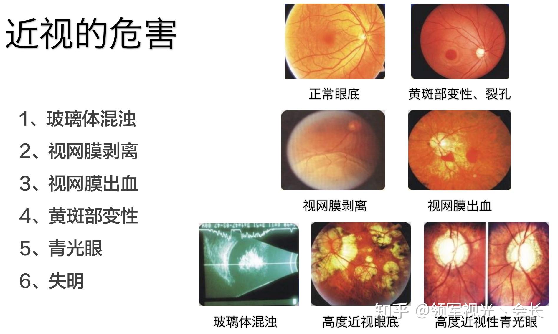 高度近视,眼底变性区,每天都焦虑怎么办? 