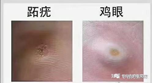 怎么区分跖疣和鸡眼? - 知乎