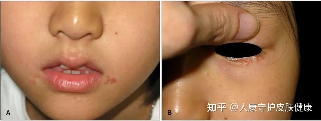 口周的皮疹≠口周皮炎，盘点那些常见的口周皮肤病 - 知乎