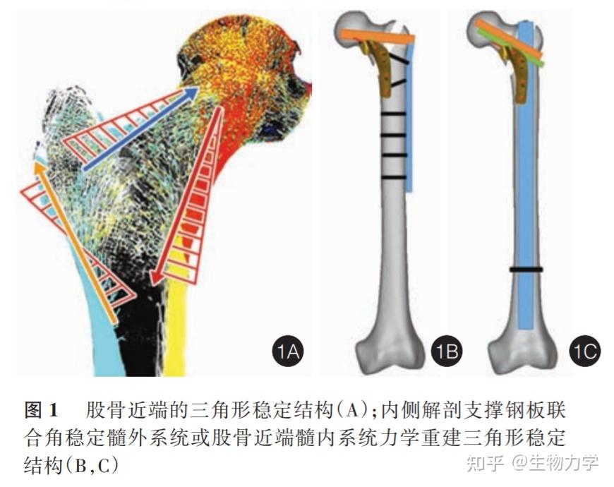 唐佩福教授团队还设计了一款新型股骨近端内侧钢板--内侧解剖支撑钢板