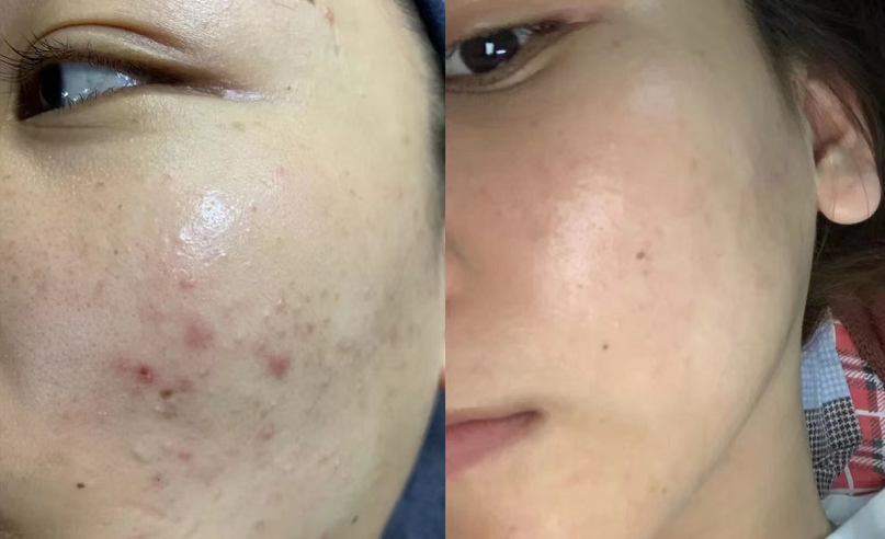 新手刷酸一次成功全网最温和的刷酸方式敏感肌的集美不允许你不知道