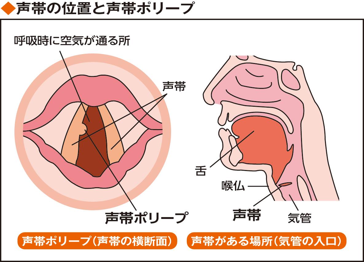 過度消耗聲帶容易引起的聲帶息肉