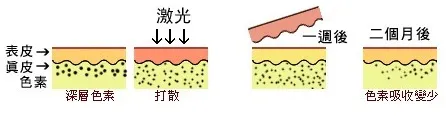 脸部激光祛斑要多少钱 医美祛斑真的有用吗？激光、皮秒、超皮秒哪个最有效？大概多少钱？