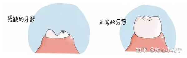 留着残根、残冠不拔会有哪些危害? - 知乎