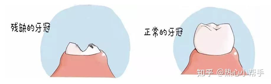 留着残根、残冠不拔会有哪些危害? - 知乎