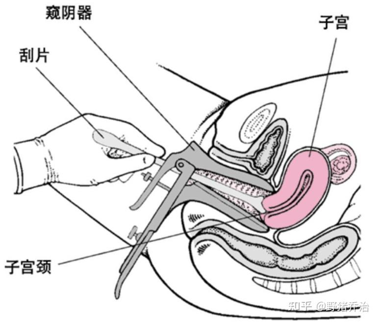 第一步子宫颈脱落细胞学检查,是筛查cin/宫颈癌的基本方法,也是诊断的