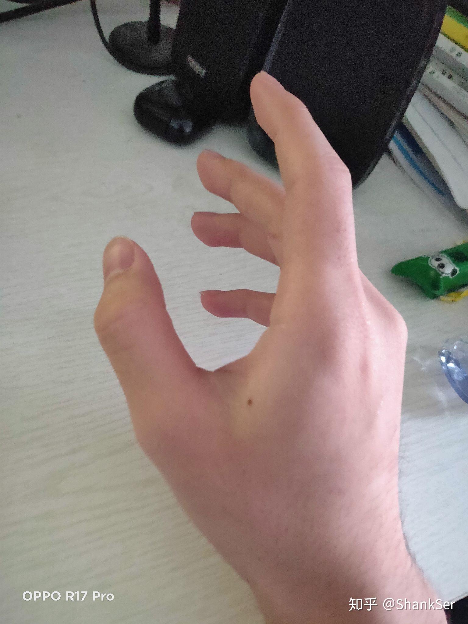 虎口上有痣的人会怎么样