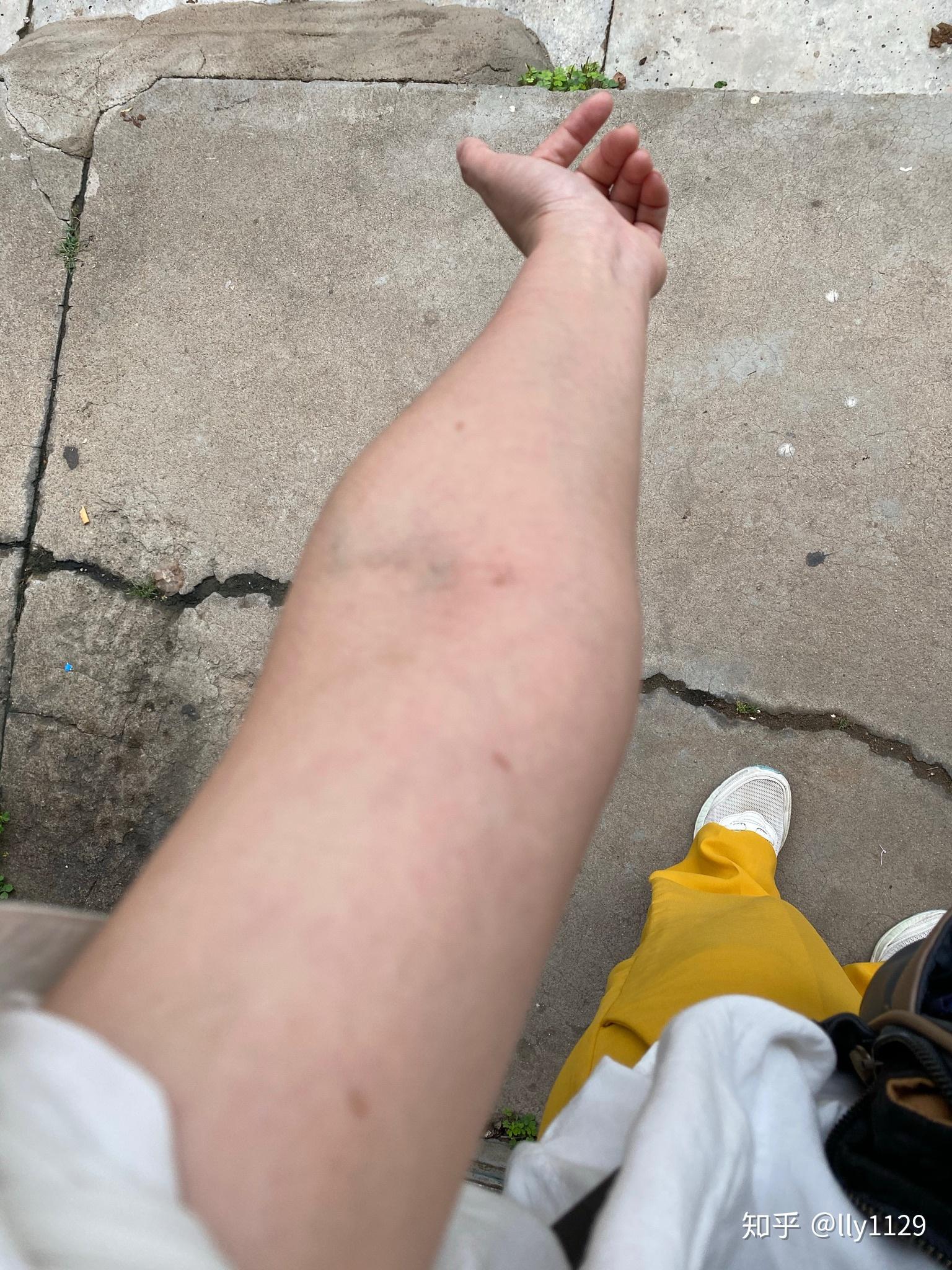 有哪位朋友知道胳膊上一夜睡醒,挨着一条线长了四个黑色印记,是什么呀