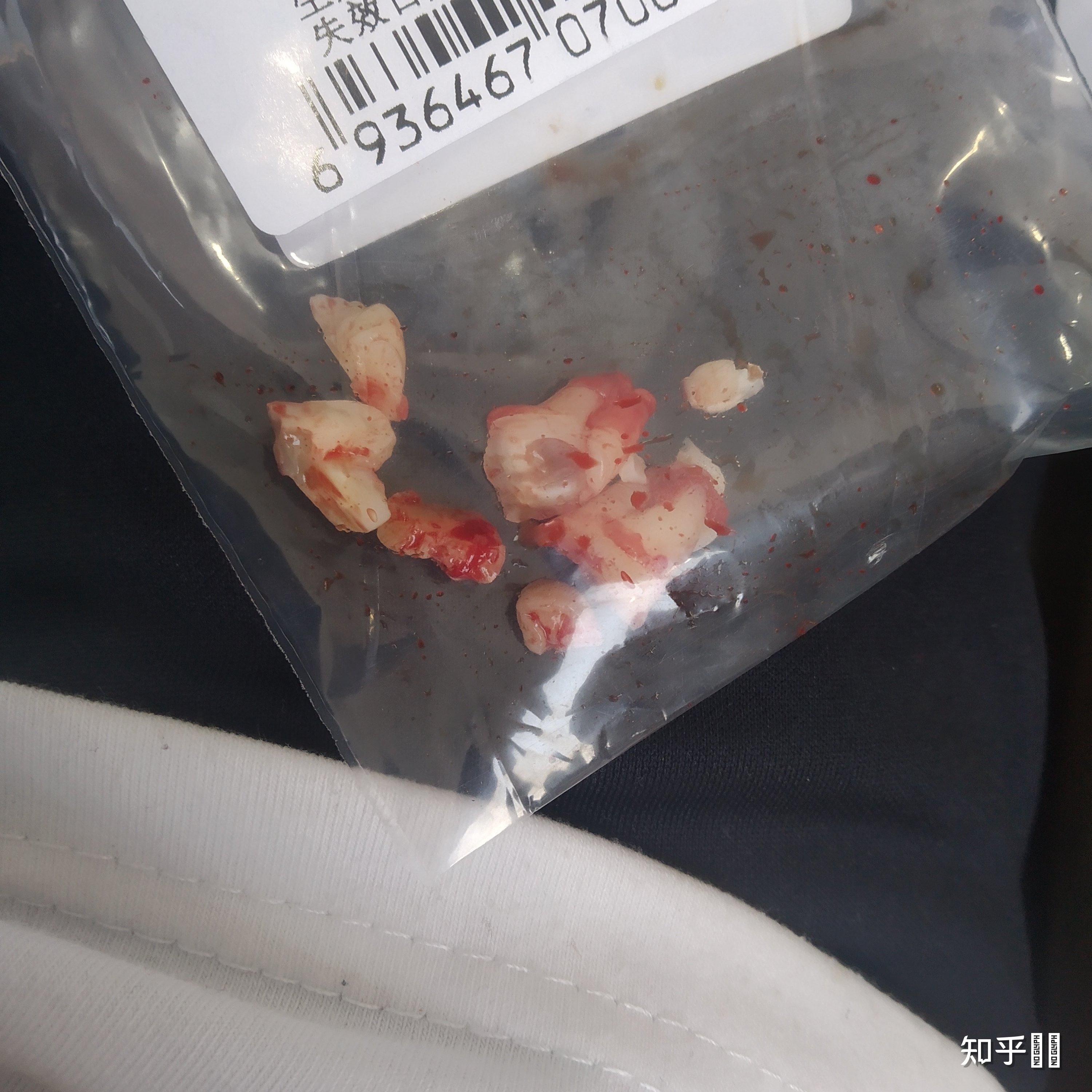 拔橫著長的智齒是怎樣的體驗