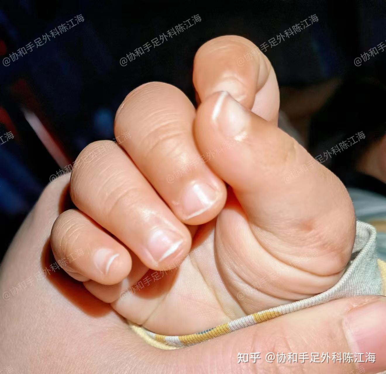 第二胎宝宝有"六指",该怎么给四岁的哥哥解释宝宝的六指问题?