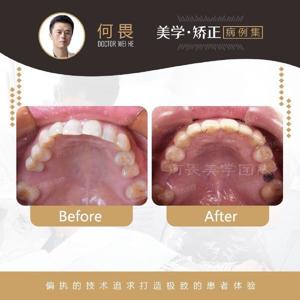 西安牙齿矫正丨浅谈牙齿矫正的价格都和那些因素有关? - 知乎