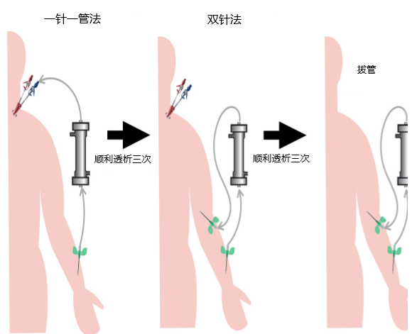 怎么样的穿刺技巧对透析内瘘比较好？ - 知乎