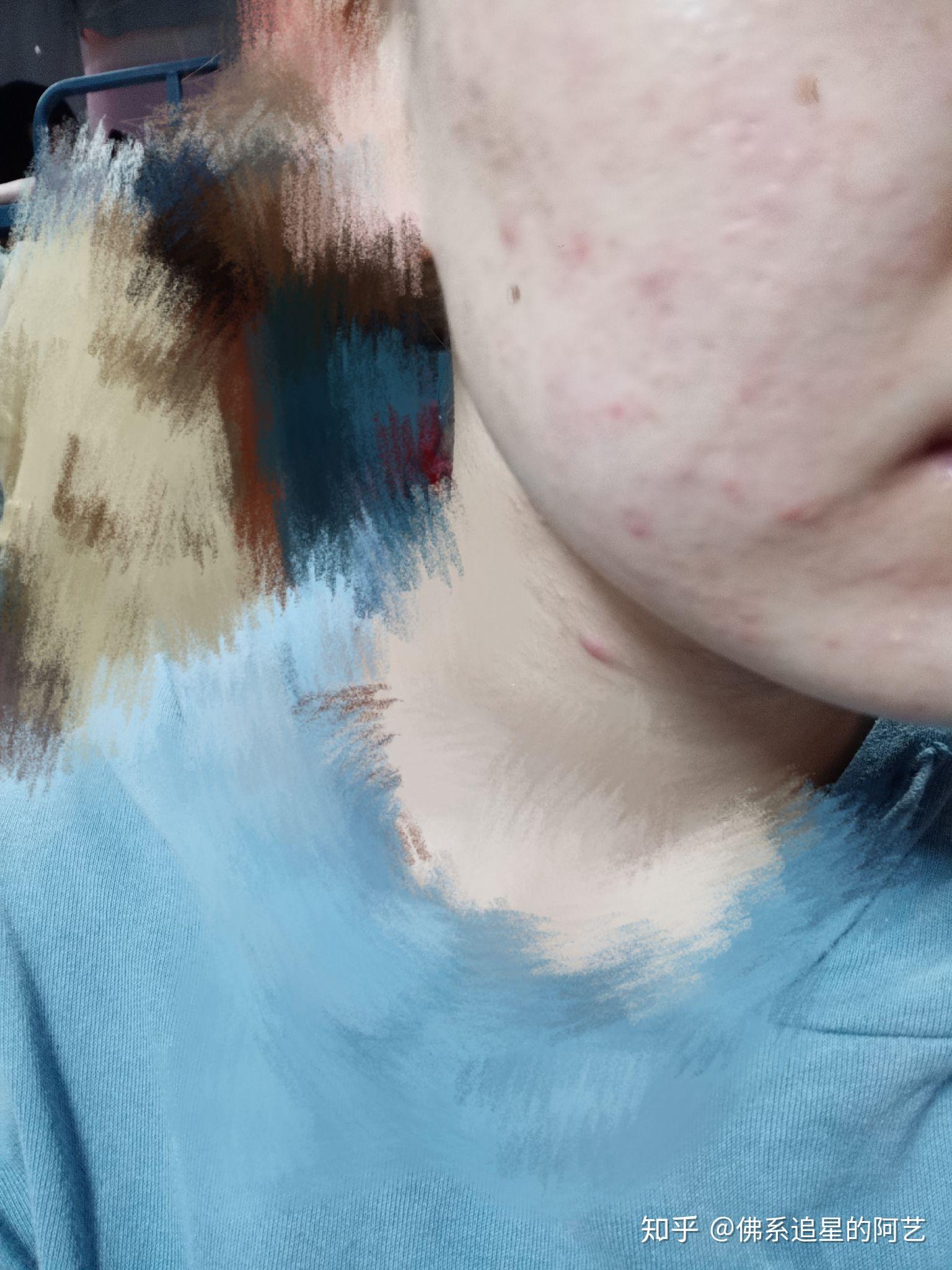 吃异维a酸软胶囊对治疗重度痤疮有效吗对身体有什么影响