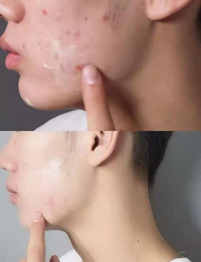 油痘肌男生该怎么选择护肤品痘痘多出油量大还有痘印