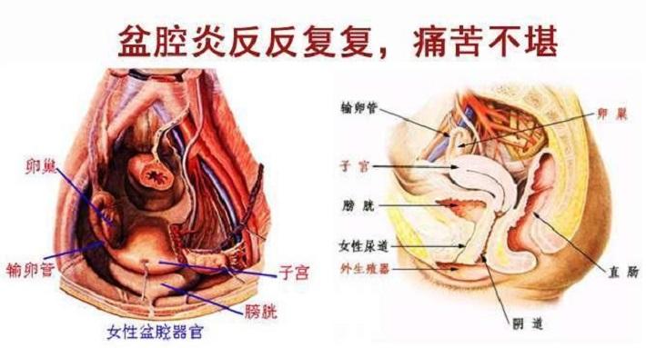 盆腔炎腰痛的位置图图片