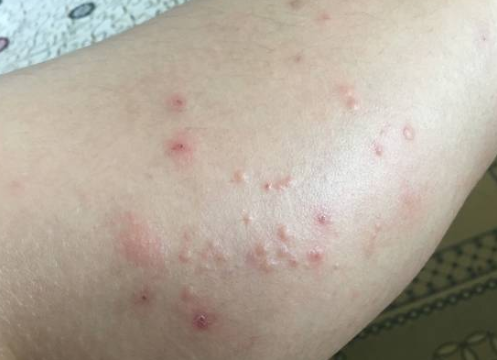 湿疹是怎样形成的