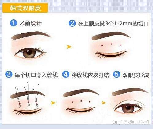 上海双眼皮医院排名_埋线双眼皮图片